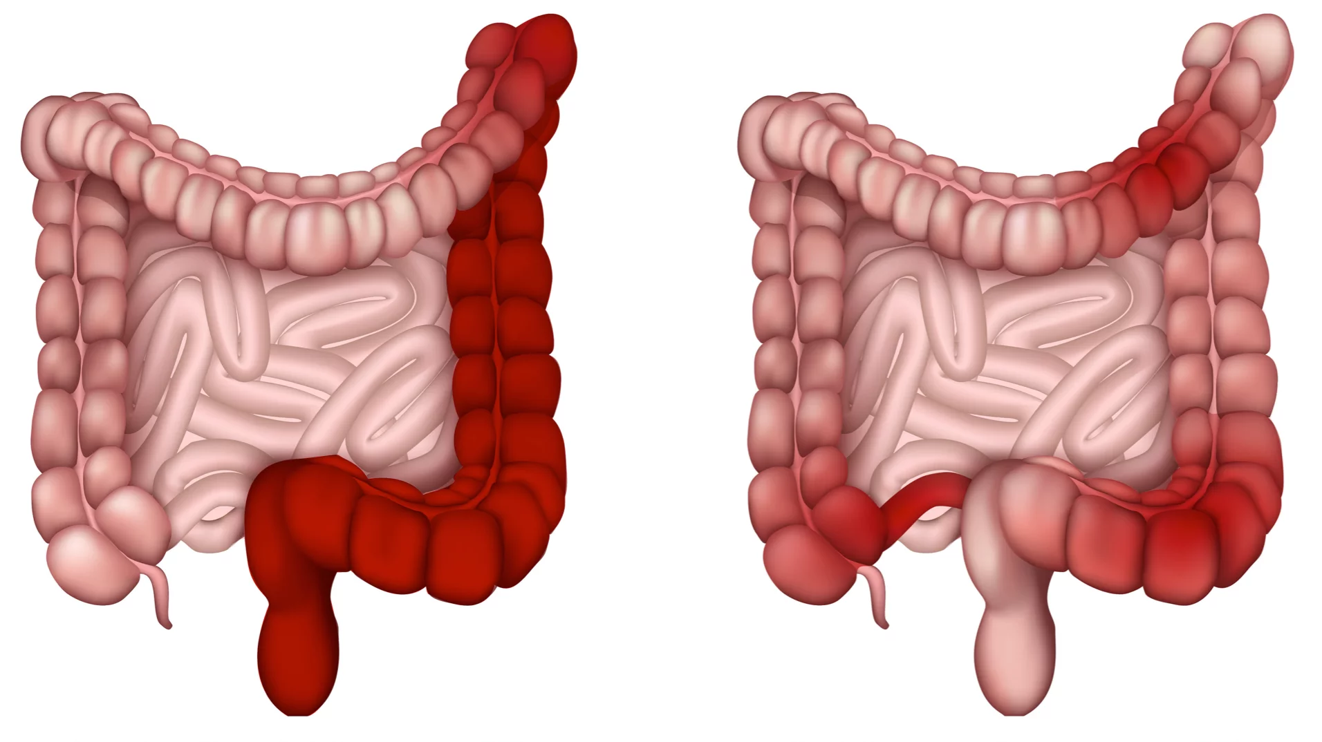 Unterschied Morbus Crohn und Colitis ulcerosa